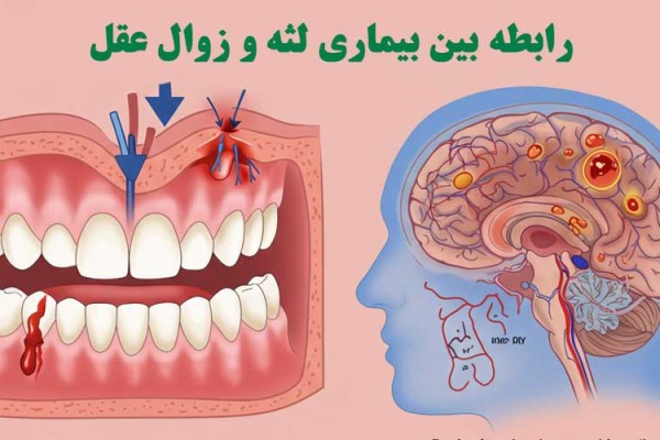 رابطه بین بیماری لثه و زوال عقل: یافته‌های یک مطالعه بزرگ