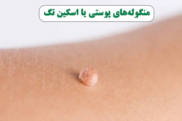 آیا منگوله های گوشتی با ظاهری ناخوشایند حاوی اخباری از درون بدنمان هستند؟!