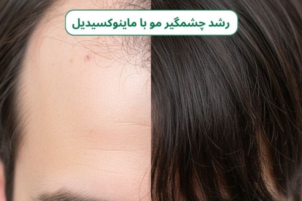 ماینوکسیدیل؛ ناجی موهای شما یا یک شمشیر دولبه؟
