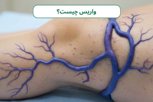 رگ‌های پیچ‌خورده: آیا واریس درمان دارد؟