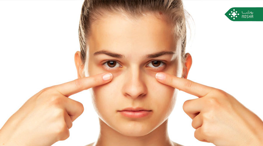 چگونه برای همیشه از شر حلقه های سیاه خلاص شویم؟ آیا راهی برای درمان تیرگی دور چشم وجود دارد؟