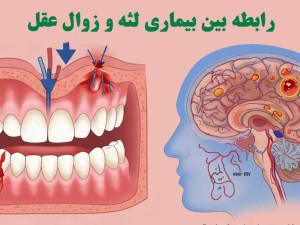 رابطه بین بیماری لثه و زوال عقل: یافته‌های یک مطالعه بزرگ