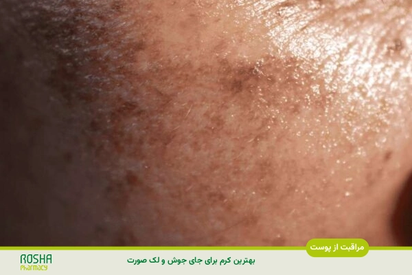 بهترین کرم برای جای جوش و لک صورت