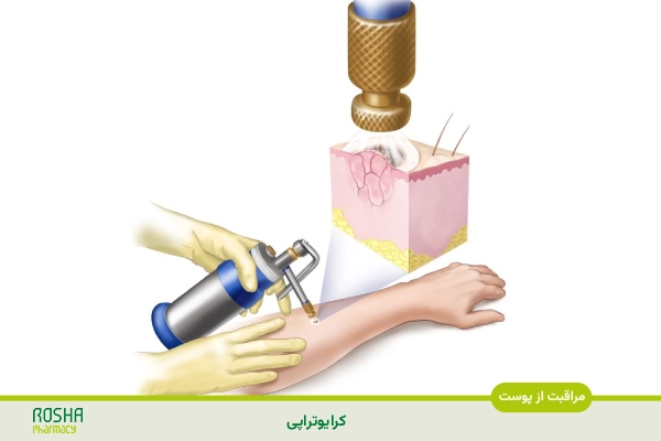 رفع کک و مک با کرایوتراپی
