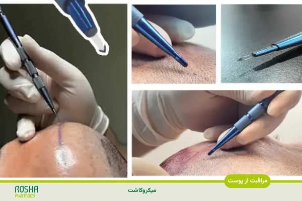 مراقبت های بعد از کاشت مو-میکروکاشت