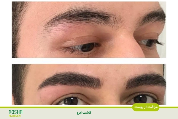 مراقبت های کاشت ابرو