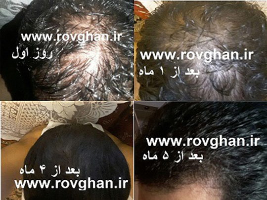 پک ضد ریزش مو