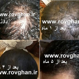 پک ضد ریزش مو