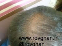 ترکیب سه روغن کاملا گیاهی و سنتی+۲قالب صابون