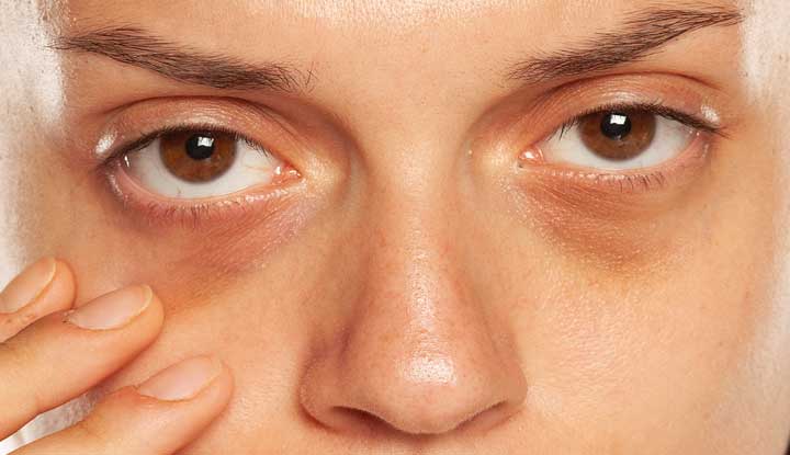 چگونه تیرگی زیر چشم را برطرف کنیم؟