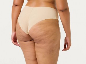 سلولیت چیست؟ دلایل، باورهای غلط و راهکارهای موثر برای از بین بردن آن (مطلب)